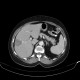 Liver metastasis, RFA, radiofrequency ablation of metastasis, after RFA: CT - Computed tomography